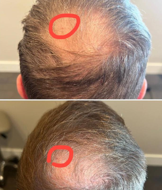 Hair Loss Treatment | Nuovo Te | Madison, WI
